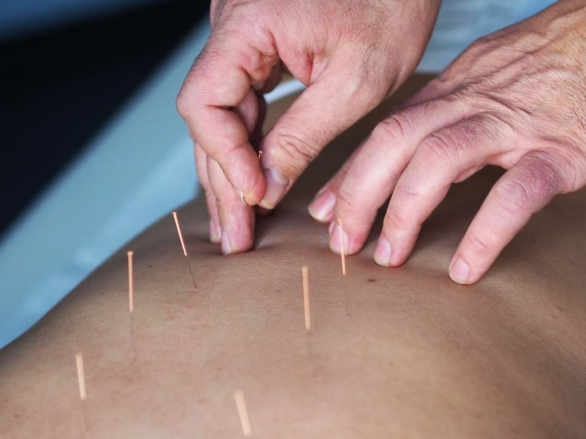Akupunktur