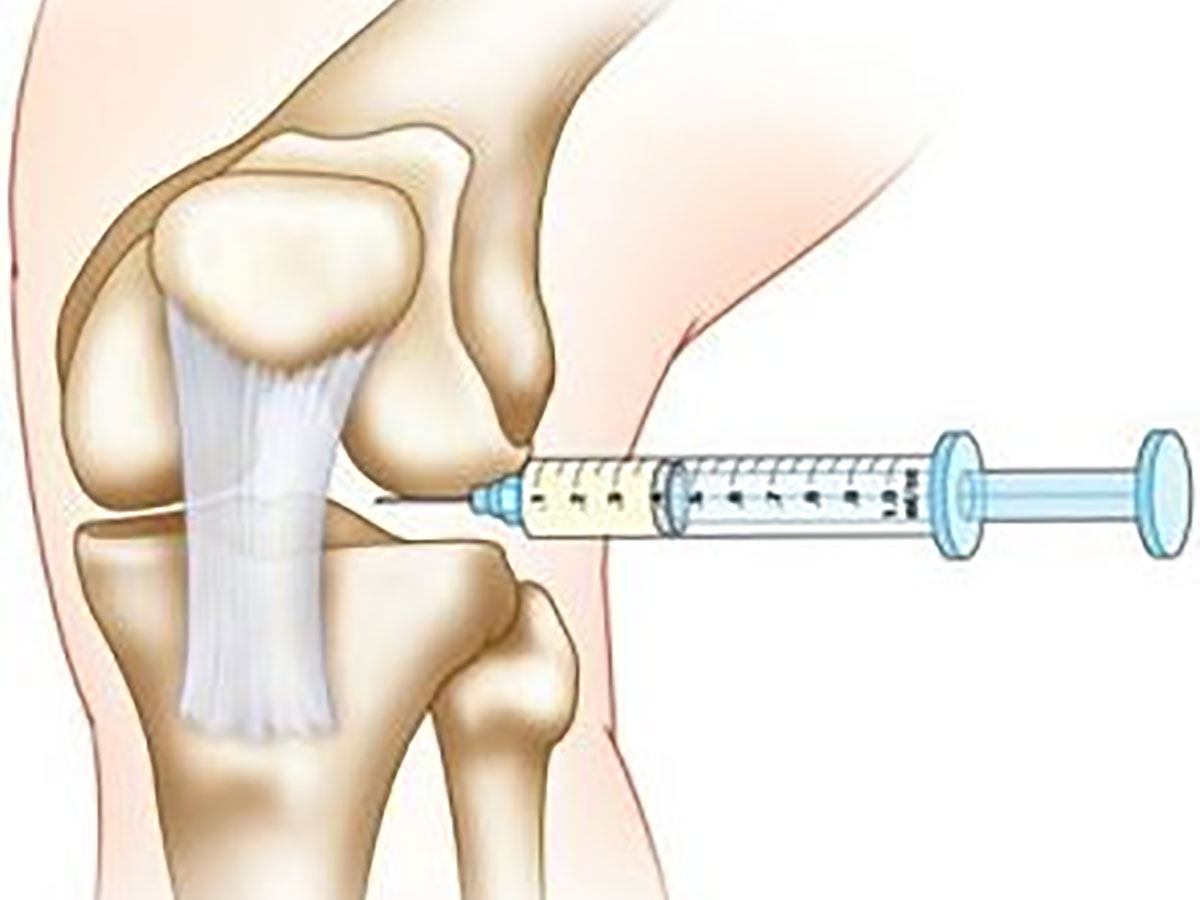 Hyaluronsäure Therapie